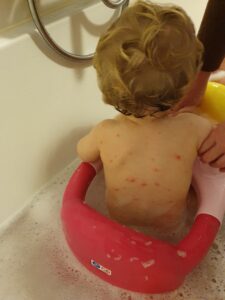 Waterpokken met blaasjes in het zemelenbad